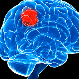 3 Signs you could have a brain tumor