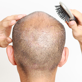 Men hair loss causes