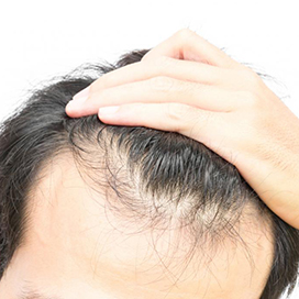 8 food prevent hair loss and increase its density