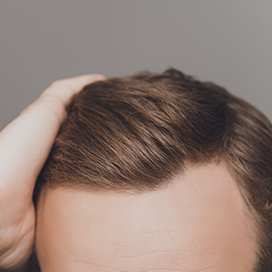 General tips for preventing hair loss and slowing baldness