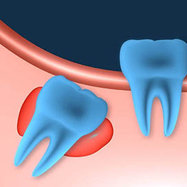 Wisdom tooth