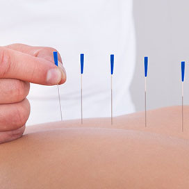 What is Acupuncture?