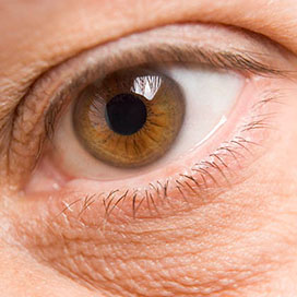 What are Under Eye Bags?